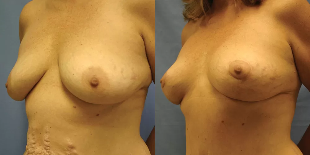 Moratis plastic surgery breast lift patient 27b