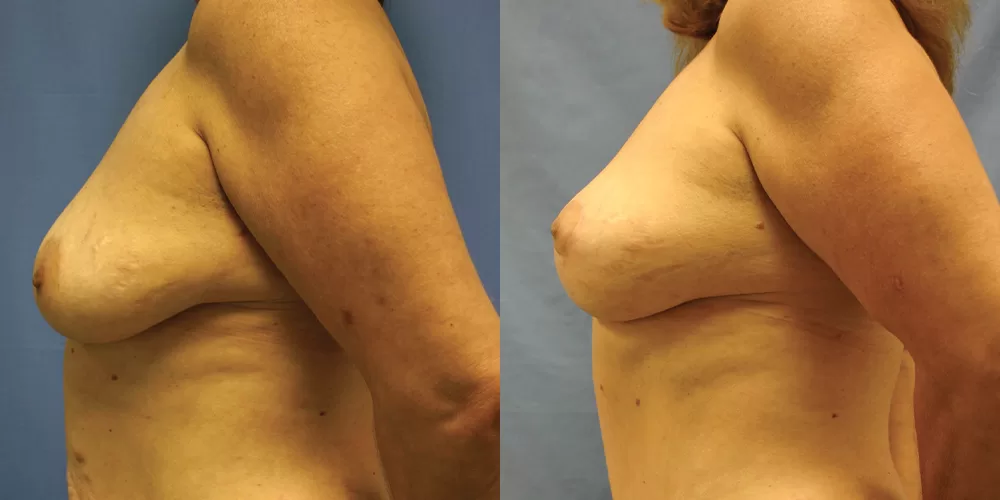 Moratis plastic surgery breast lift patient 27c
