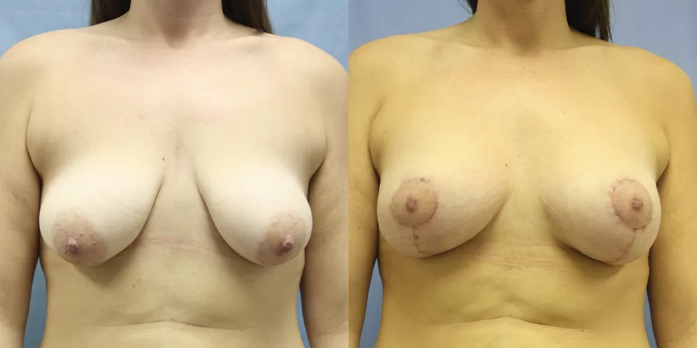 Moratis plastic surgery breast lift patient 28a