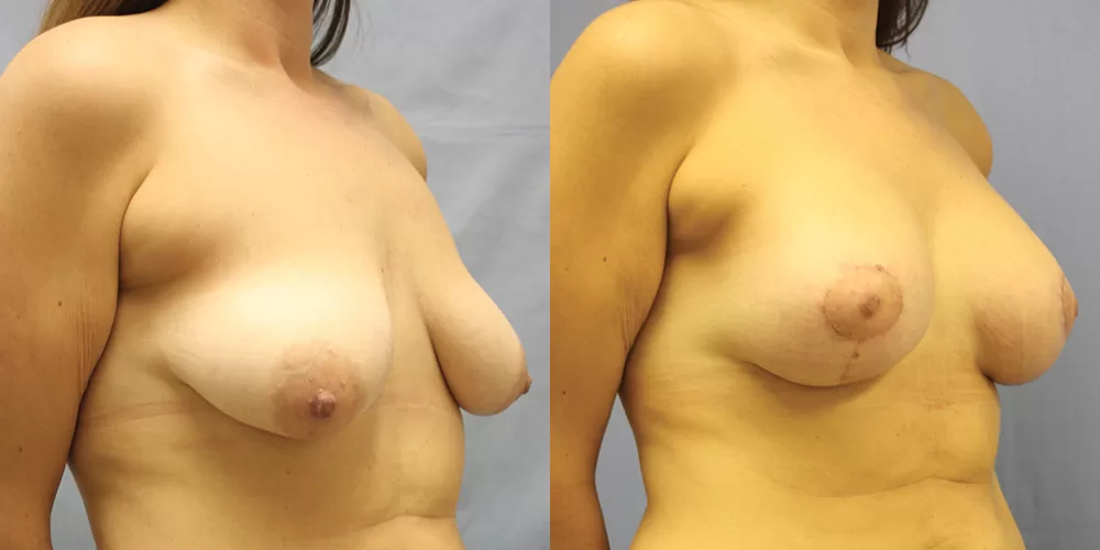 Moratis plastic surgery breast lift patient 28b