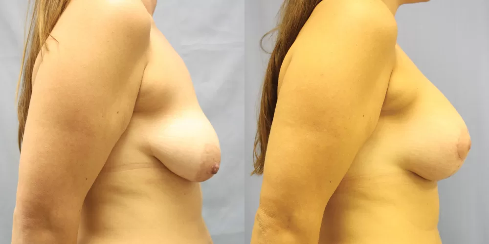 Moratis plastic surgery breast lift patient 28c