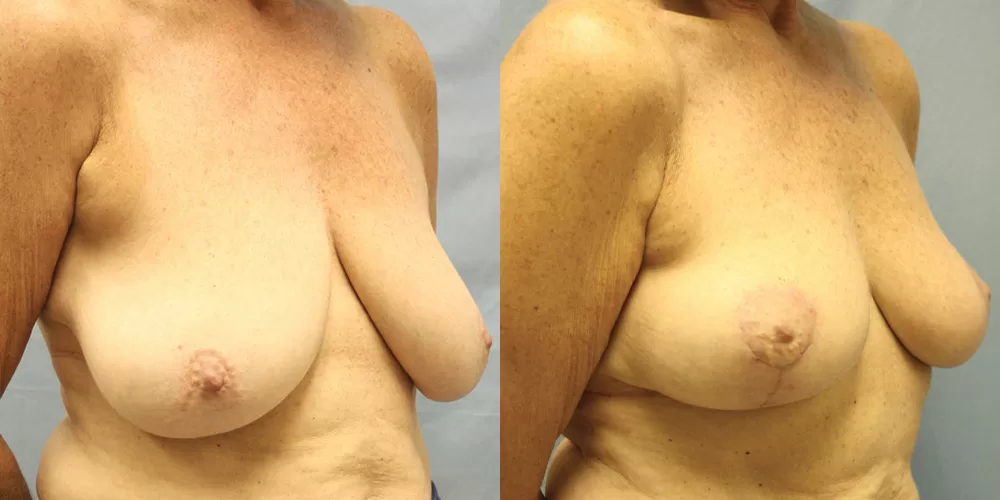 Moratis plastic surgery breast lift patient 29b