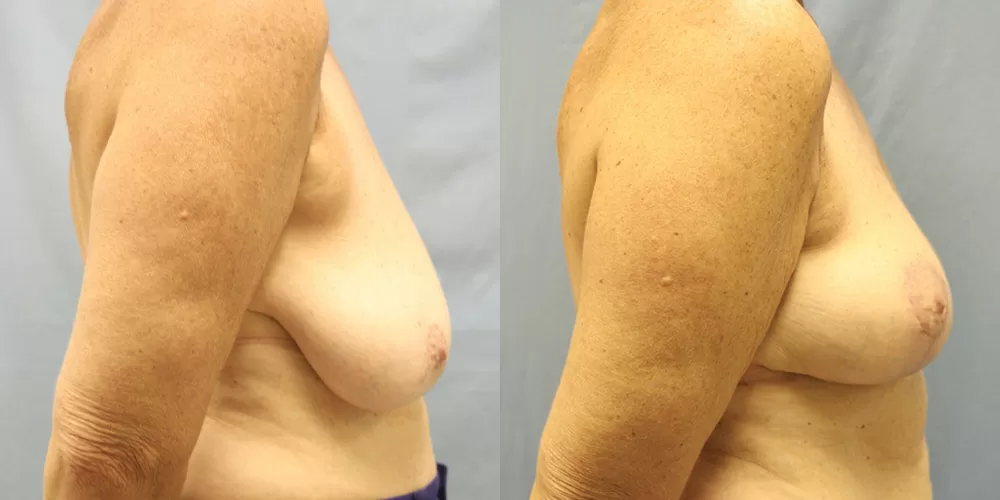 Moratis plastic surgery breast lift patient 29c