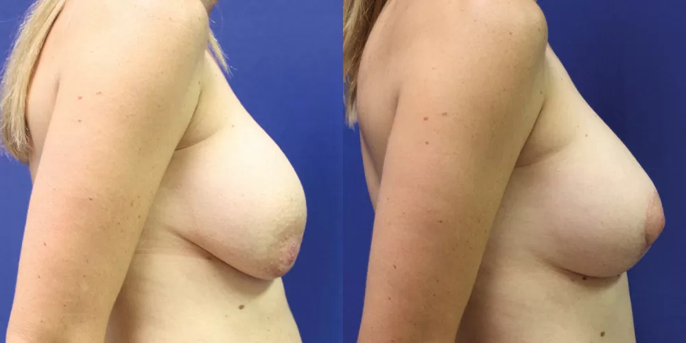 Moratis plastic surgery breast lift patient 30c