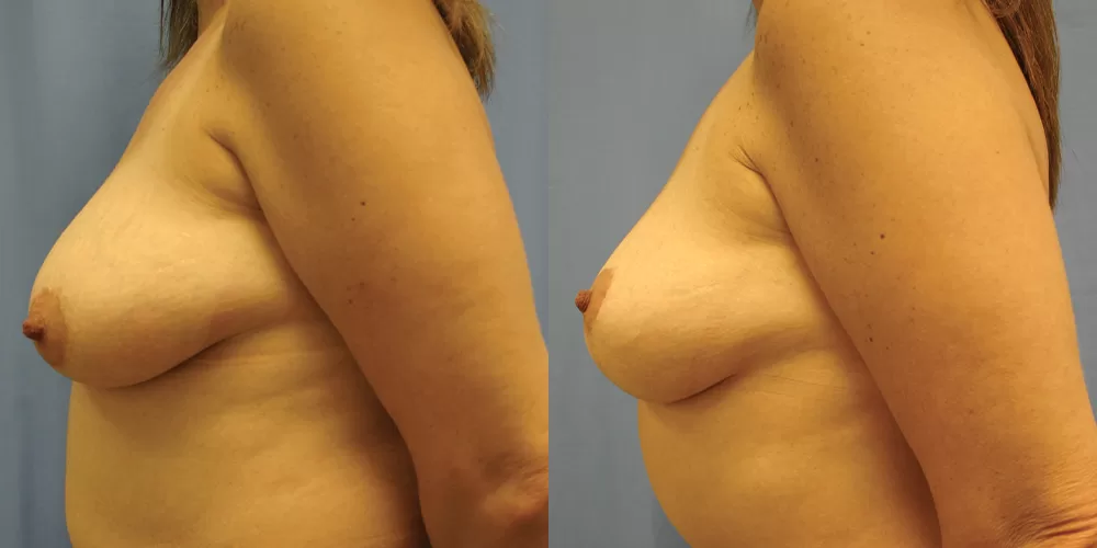 Moratis plastic surgery breast lift patient 31b