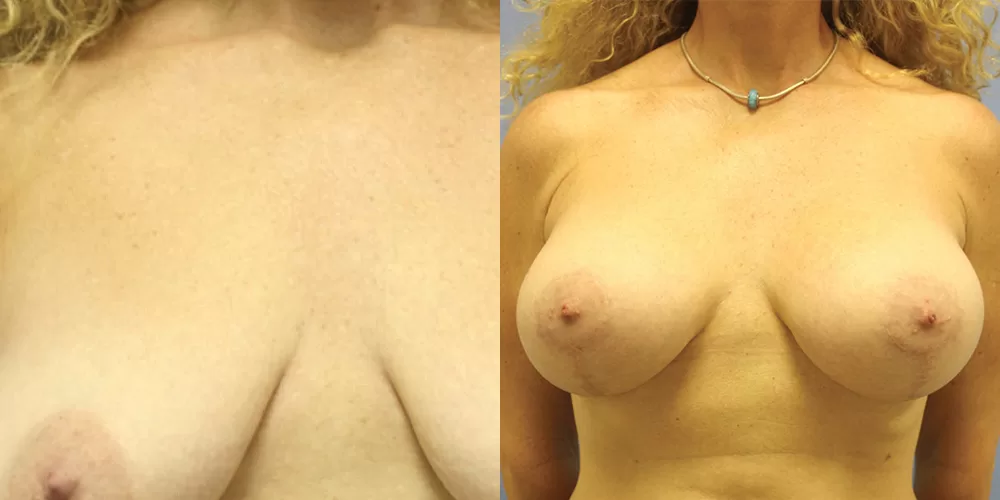 Moratis plastic surgery breast lift patient 33a