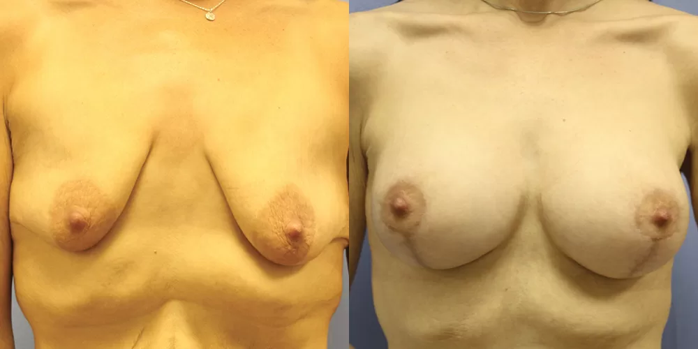 Moratis plastic surgery breast lift patient 34a