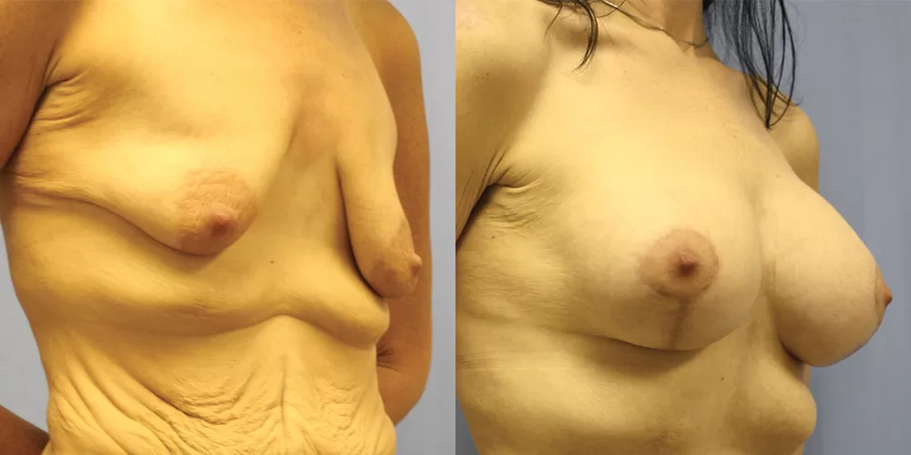 Moratis plastic surgery breast lift patient 34b
