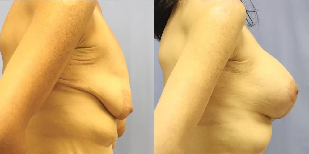 Moratis plastic surgery breast lift patient 34c