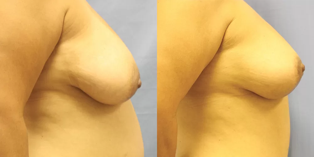 Moratis plastic surgery breast lift patient 36c