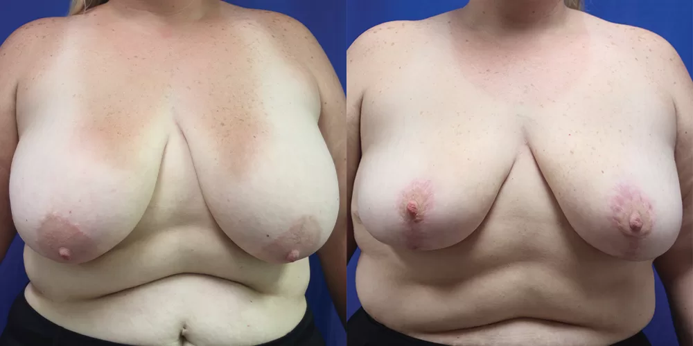 Moratis plastic surgery breast reduction patient 3a