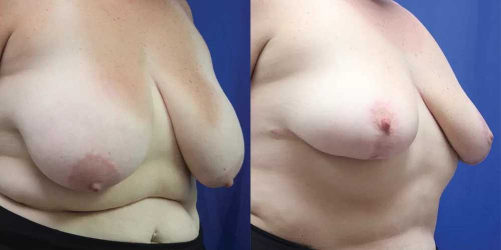Moratis plastic surgery breast reduction patient 3b