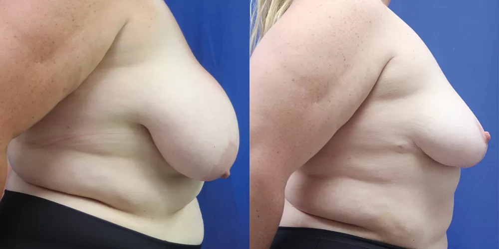 Moratis plastic surgery breast reduction patient 3c