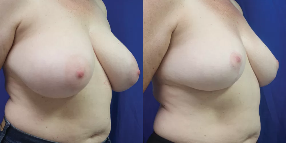 Moratis plastic surgery breast reduction patient 5b