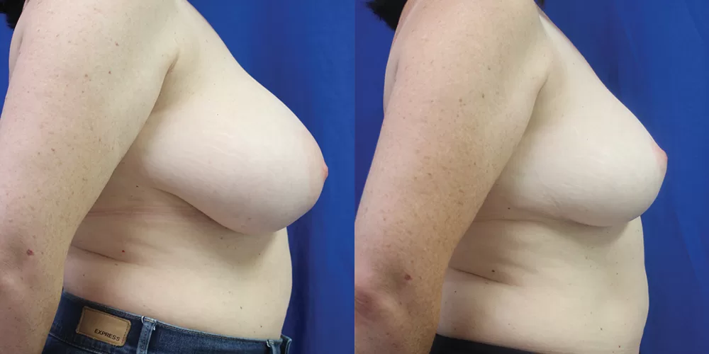 Moratis plastic surgery breast reduction patient 5c