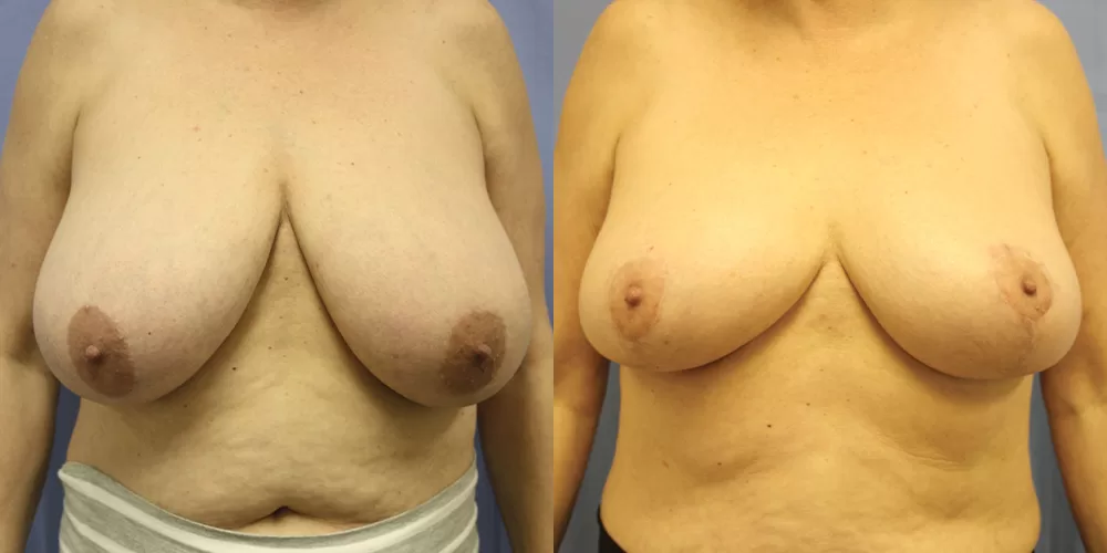 Moratis plastic surgery breast reduction patient 6a