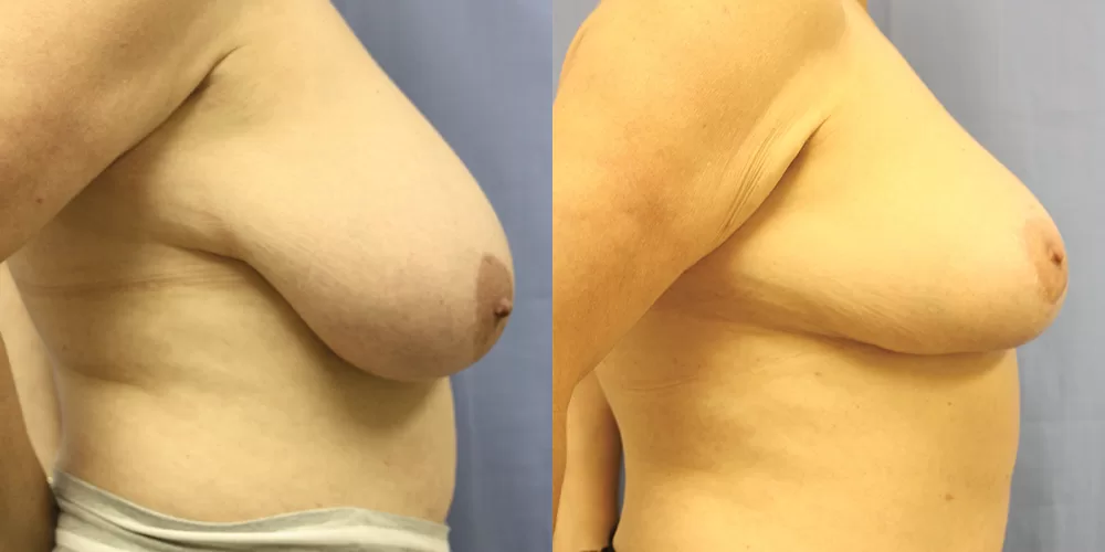 Moratis plastic surgery breast reduction patient 6c