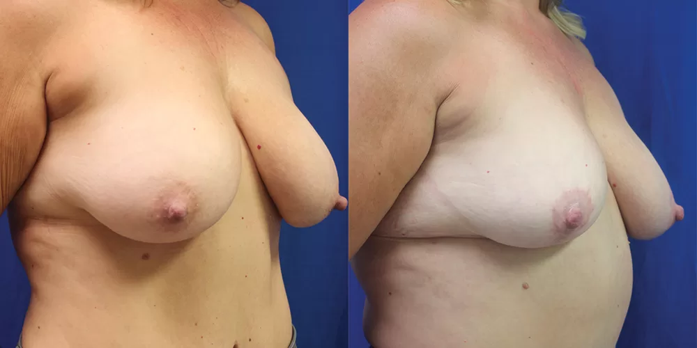 Moratis plastic surgery breast reduction patient 7b