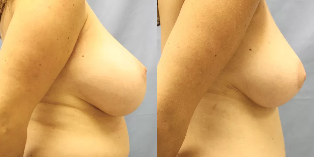 Moratis plastic surgery breast reduction patient 8c