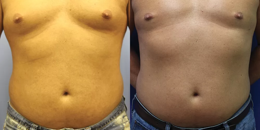 Moratis plastic surgery liposuction patient 10a