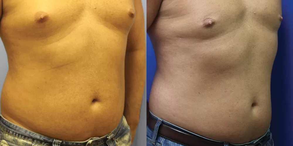 Moratis plastic surgery liposuction patient 10b