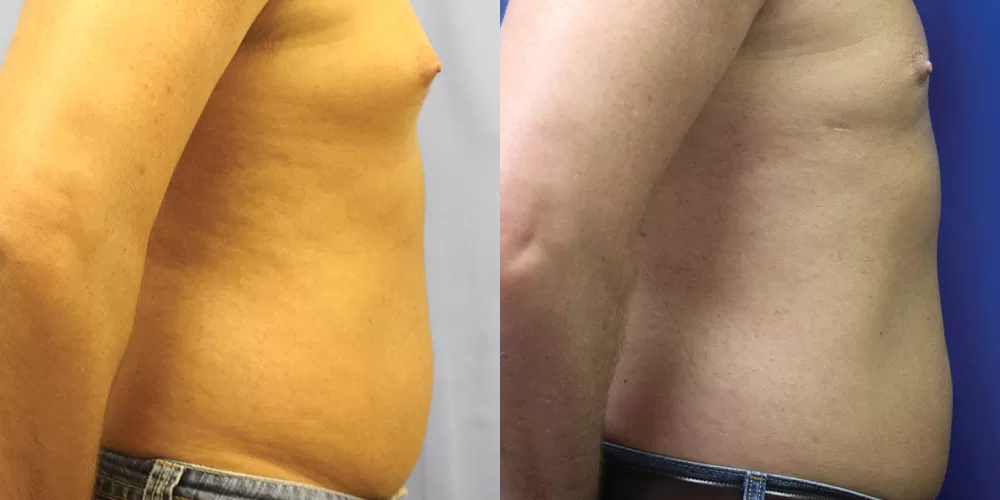Moratis plastic surgery liposuction patient 10c