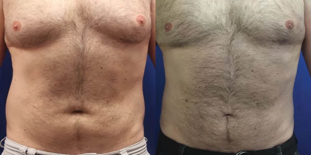 Moratis plastic surgery liposuction patient 11a