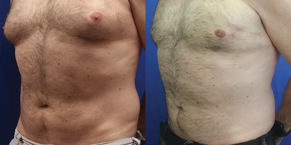 Moratis plastic surgery liposuction patient 11b