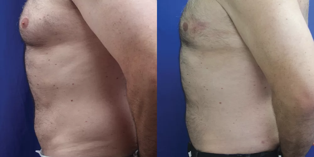 Moratis plastic surgery liposuction patient 11c
