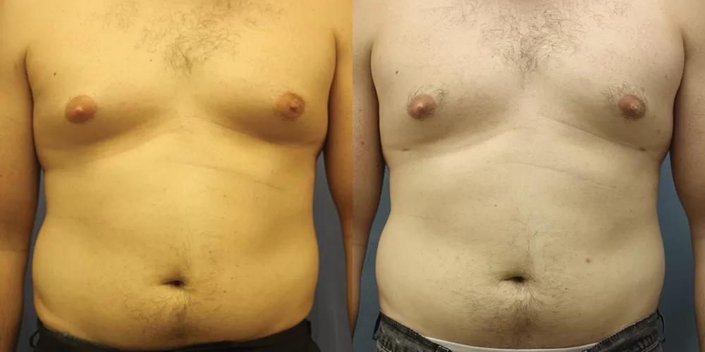 Moratis plastic surgery liposuction patient 12a