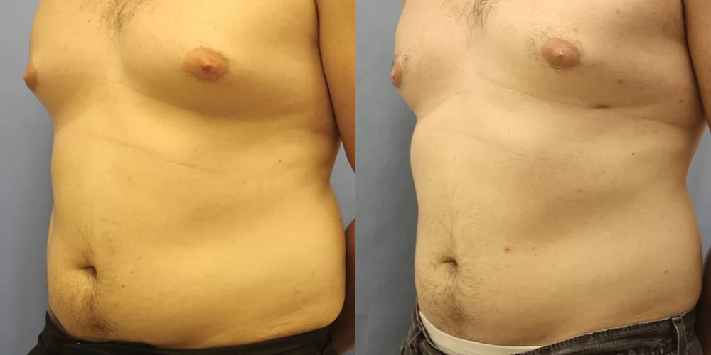 Moratis plastic surgery liposuction patient 12b