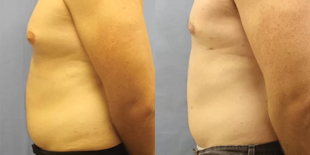 Moratis plastic surgery liposuction patient 12c