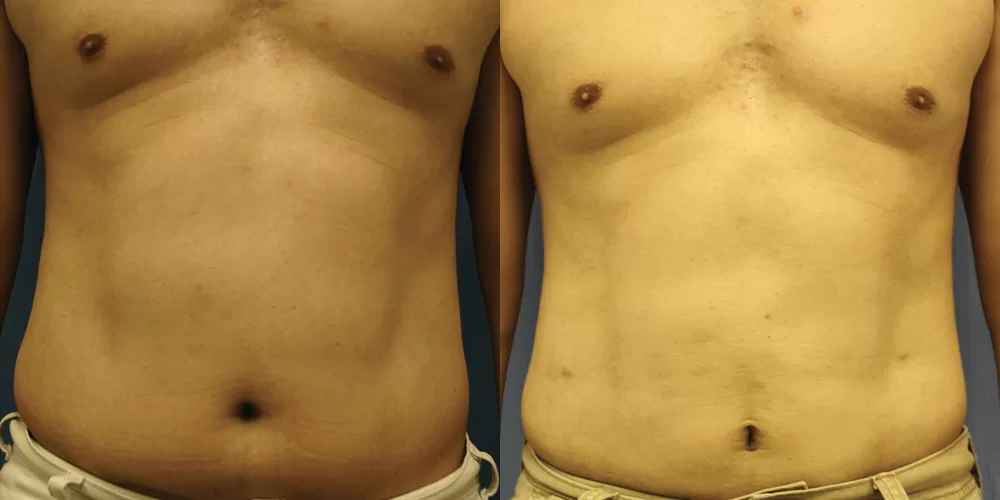Moratis plastic surgery liposuction patient 13a