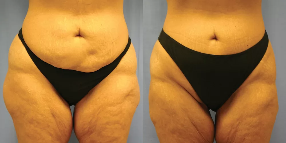 Moratis plastic surgery liposuction patient 14a