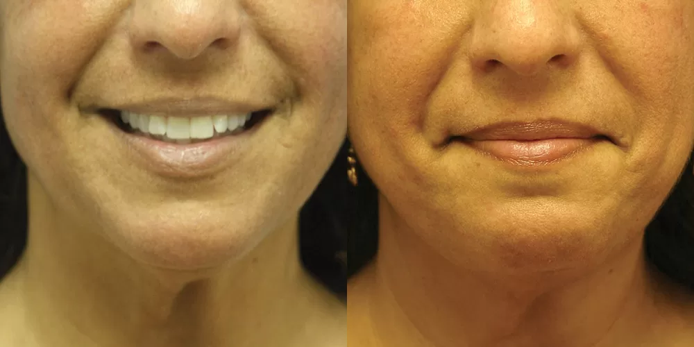Moratis plastic surgery liposuction patient 15a