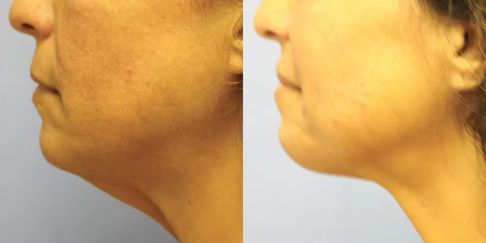 Moratis plastic surgery liposuction patient 15b