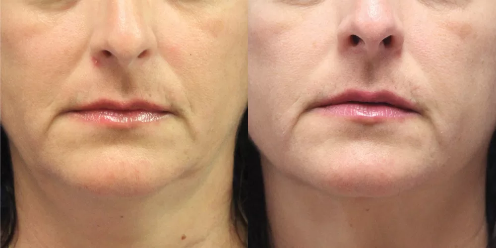 Moratis plastic surgery liposuction patient 16a