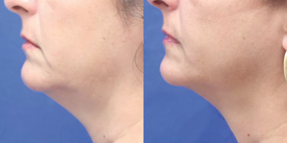 Moratis plastic surgery liposuction patient 16b