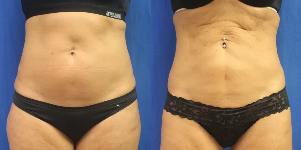 Moratis plastic surgery liposuction patient 8a