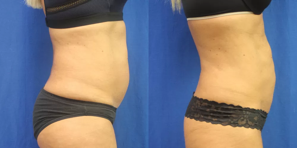 Moratis plastic surgery liposuction patient 8b