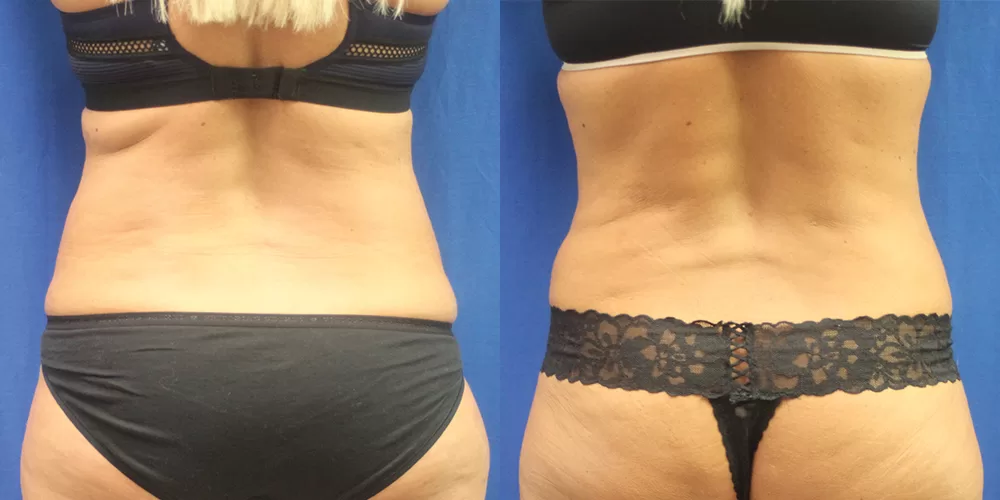 Moratis plastic surgery liposuction patient 8c