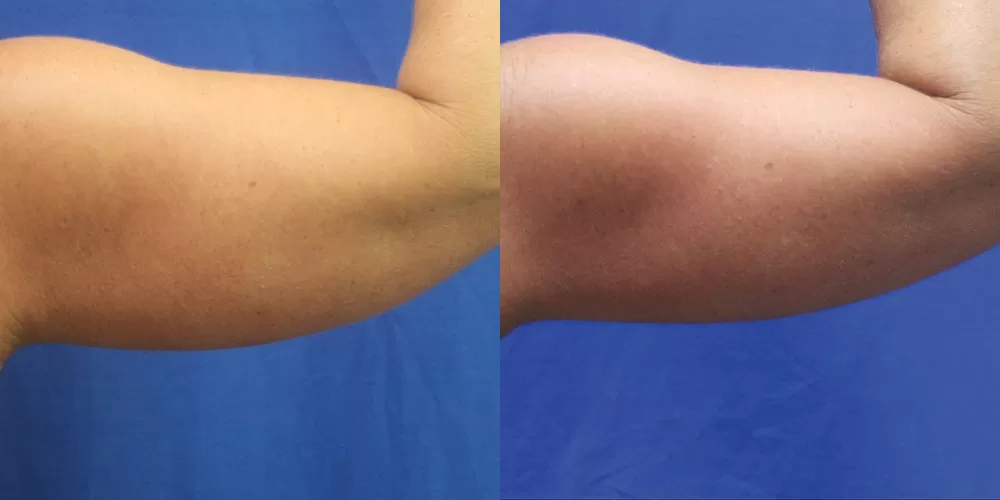 Moratis plastic surgery liposuction patient 9a