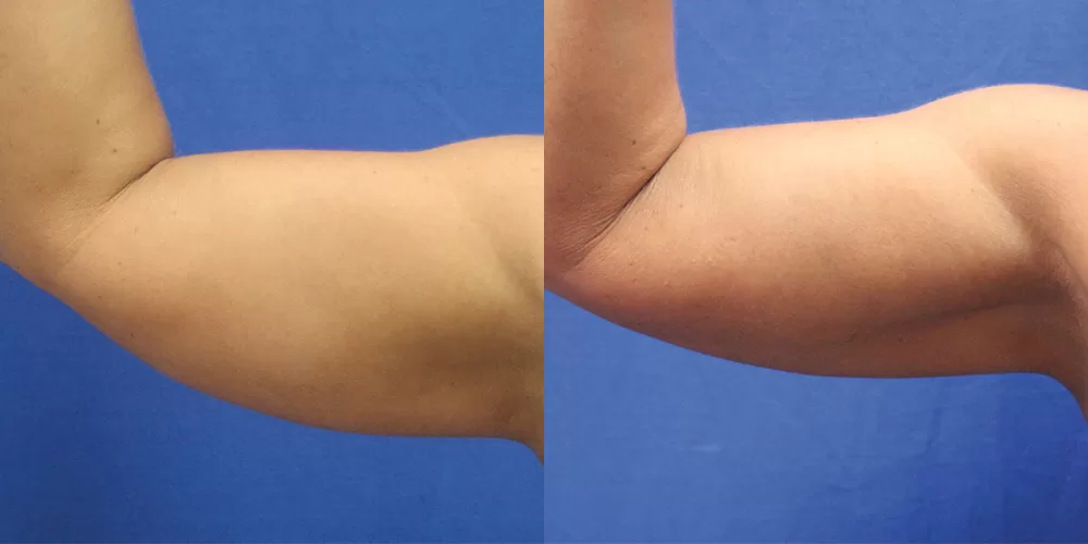 Moratis plastic surgery liposuction patient 9b