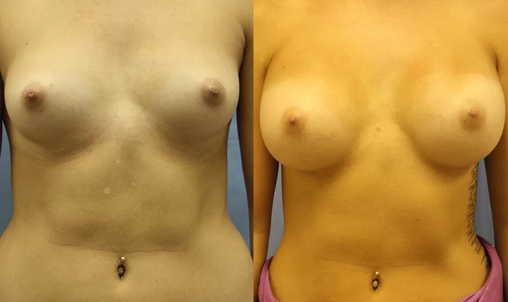 Patient 13a breast augmentation before and after
