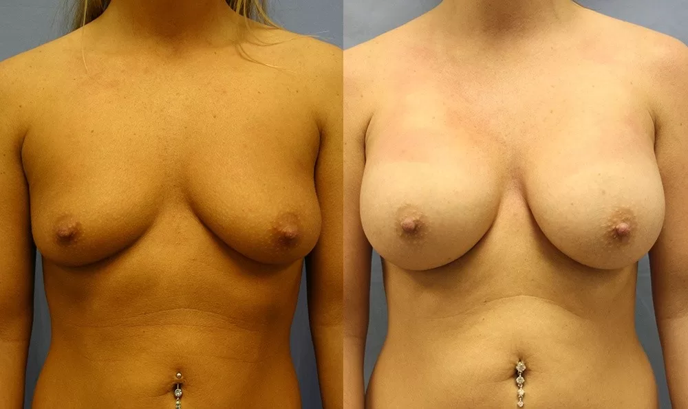 Patient 24a breast augmentation before and after