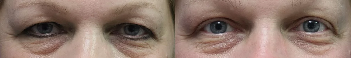Patient 3 blepharoplasty before and after