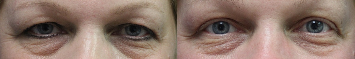 Patient 3 Blepharoplasty Before and After