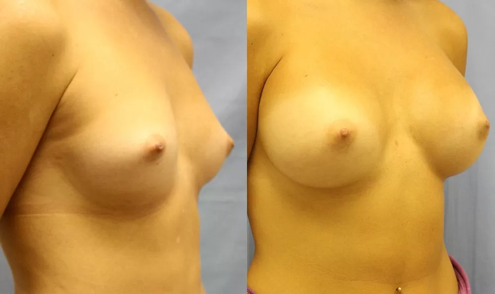 Patient 13b breast augmentation before and after
