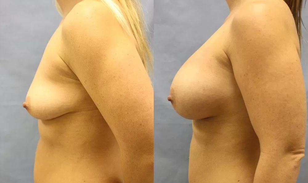 Patient 24b breast augmentation before and after