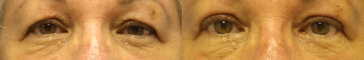Patient 4 blepharoplasty before and after